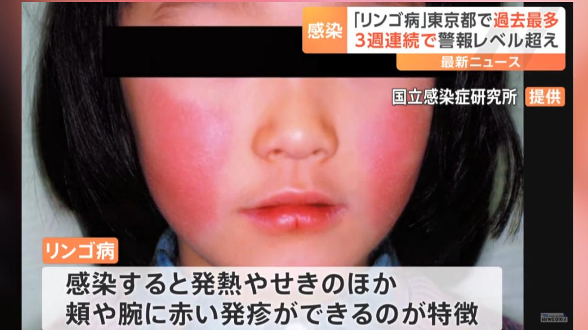 赴日注意!東京「蘋果病」患者數創新高 孕婦感染恐流產