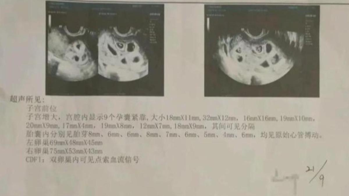 江西女子懷上九胞胎。(圖/翻攝自微博)