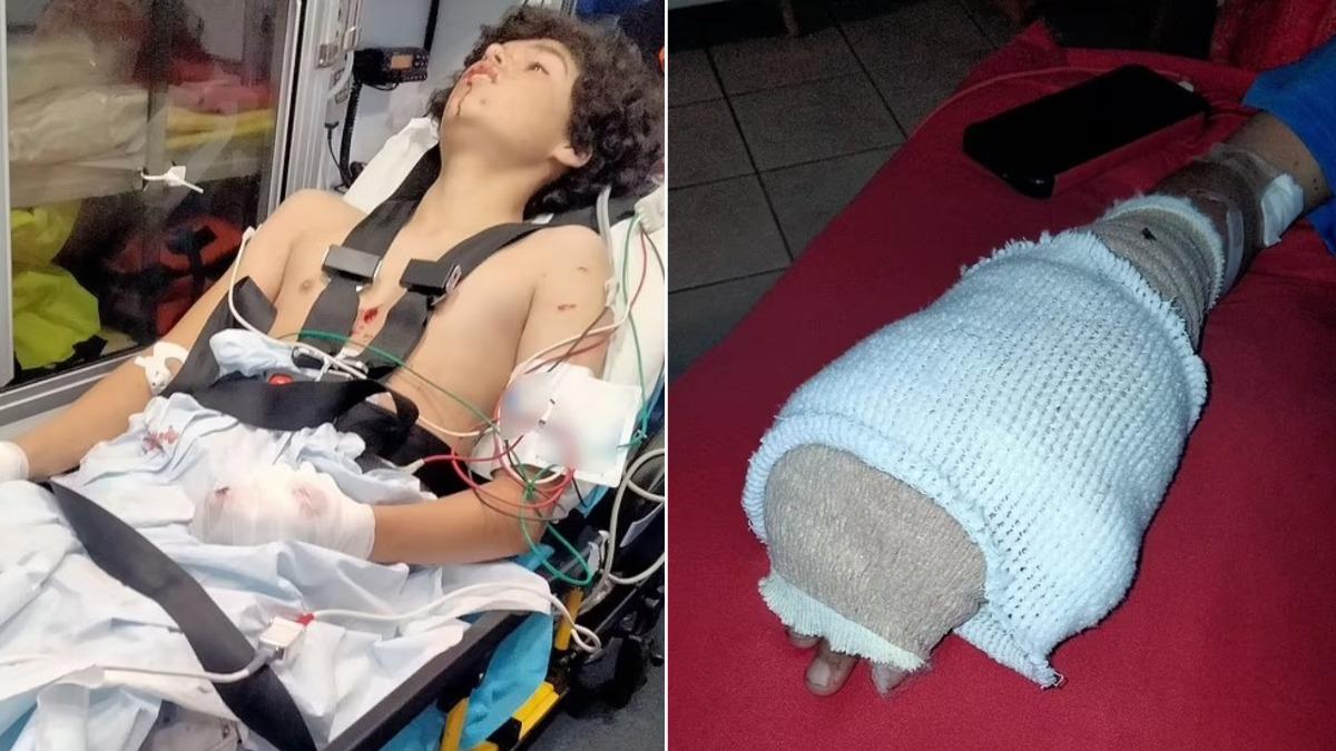 美15歲少年抽電子菸突然爆炸!手掌被「炸到外翻」還截肢