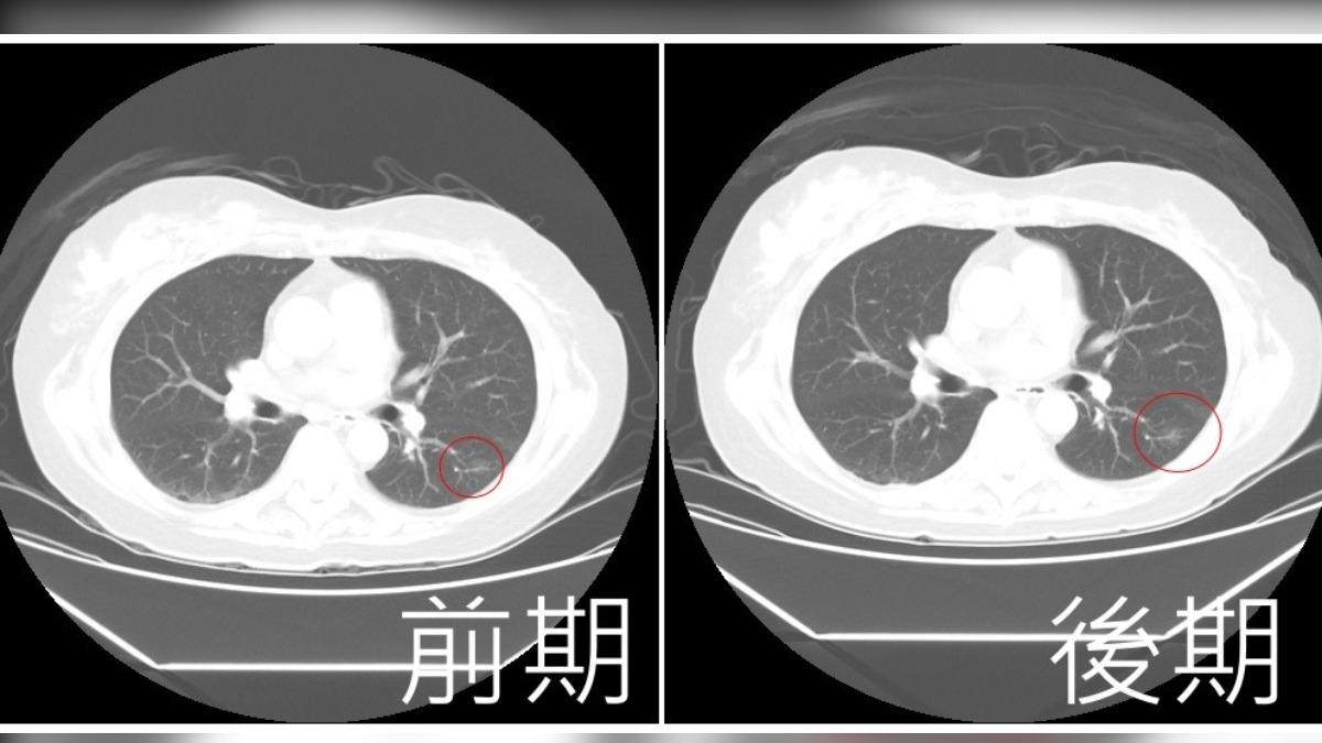 台中嬤不抽菸罹十大癌榜首 「不痛不癢拖2年」大一倍