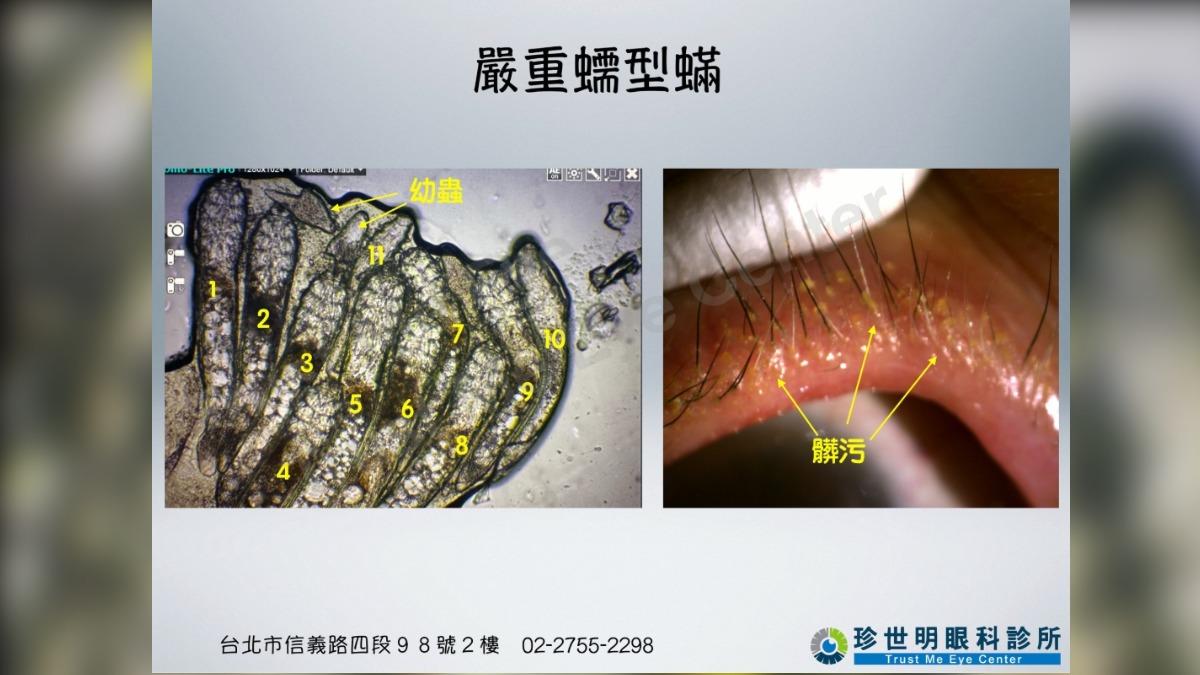 女子眼部發癢求診，睫毛上都是蟲。（圖／翻攝自王孟祺臉書粉專）