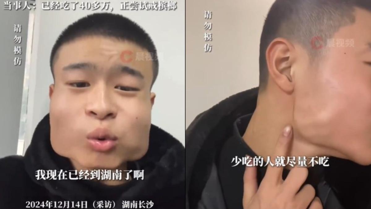 男子長期吃檳榔變方塊臉。（圖／翻攝自微博《瀟湘晨報》）