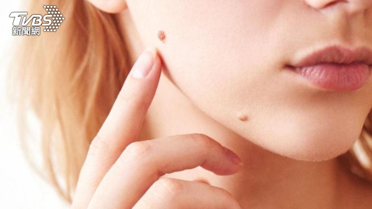 快找臉上5種痣「天生貴人運」旺到停不了。（示意圖／shutterstock達志影像）