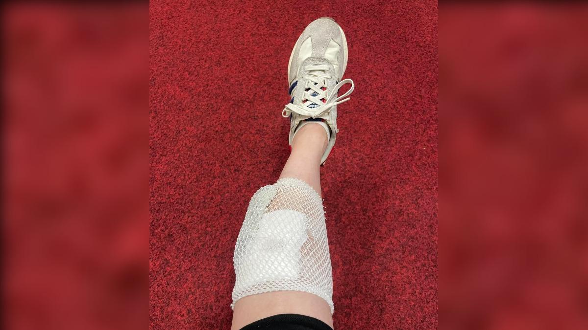 藍綠肉搏！陳亭妃秀腿傷照　嘆遇到國民黨這2人「還是受傷了」