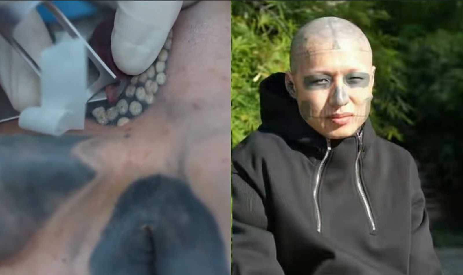 男子決心清除全身刺青,但因無法忍耐過程中的劇痛,只能暫時中斷。(圖/翻攝自微博)