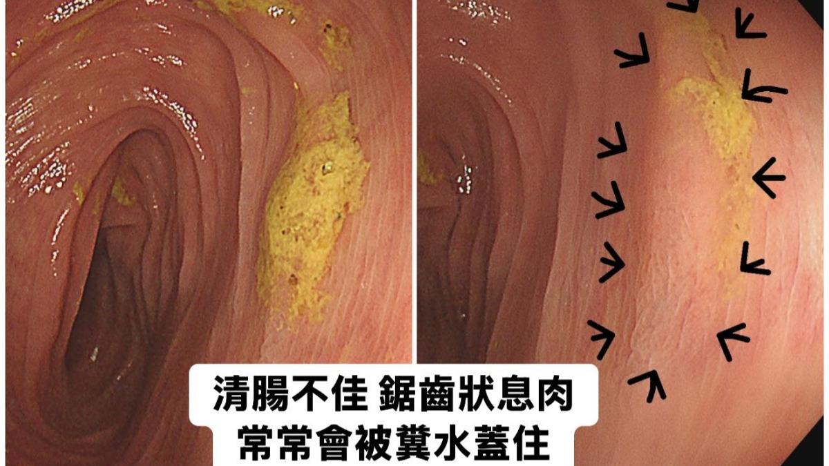 林相宏表示,鋸齒狀息肉常常被糞水蓋住,常常讓醫師忽略。(圖/翻攝自林相宏臉書)
