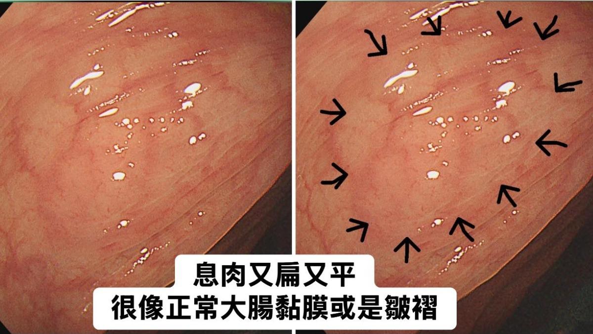 20歲女胃痛、脹氣!大腸鏡一照「息肉超驚人」 醫:強烈癌化風險