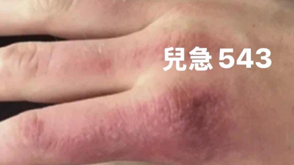 少女治青春痘現皮膚紅斑!吃藥「光敏感」醫:恐全身性皮膚病變