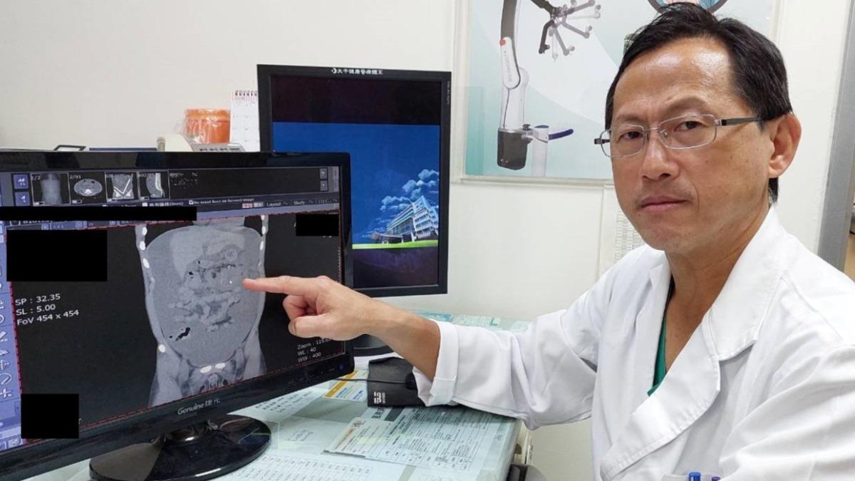 大腸癌年輕化！15歲少年無家族病史　「腹脹、身體虛」已4期
