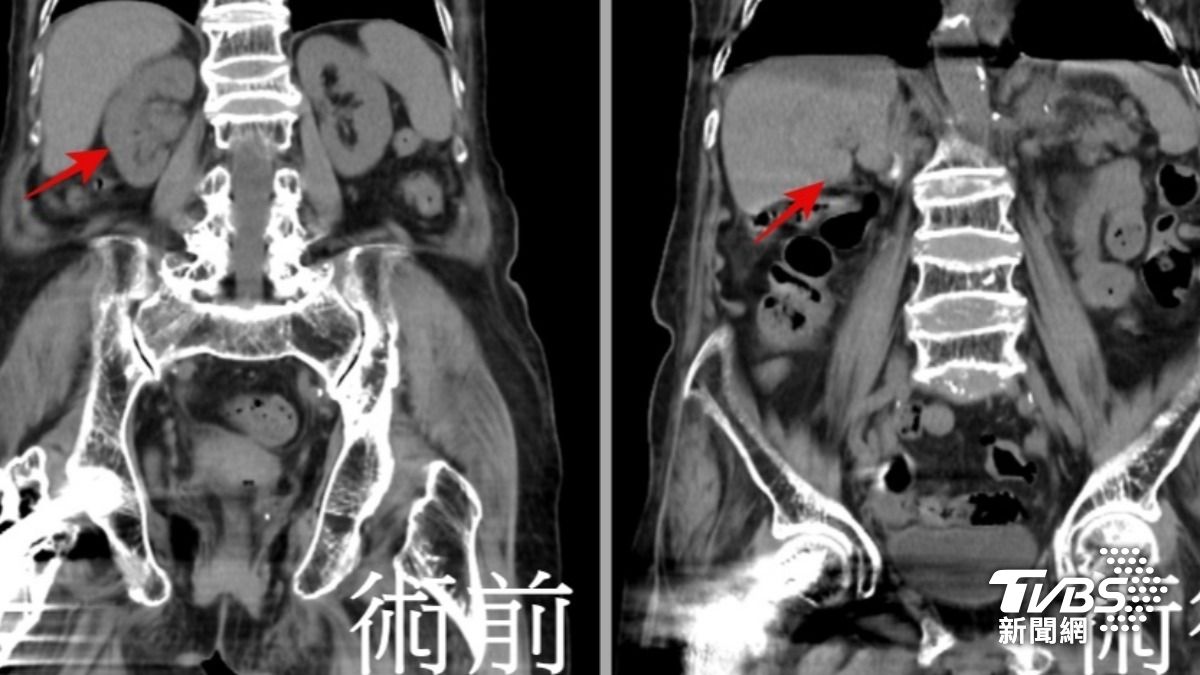 95歲嬤罹癌。(圖/TVBS)
