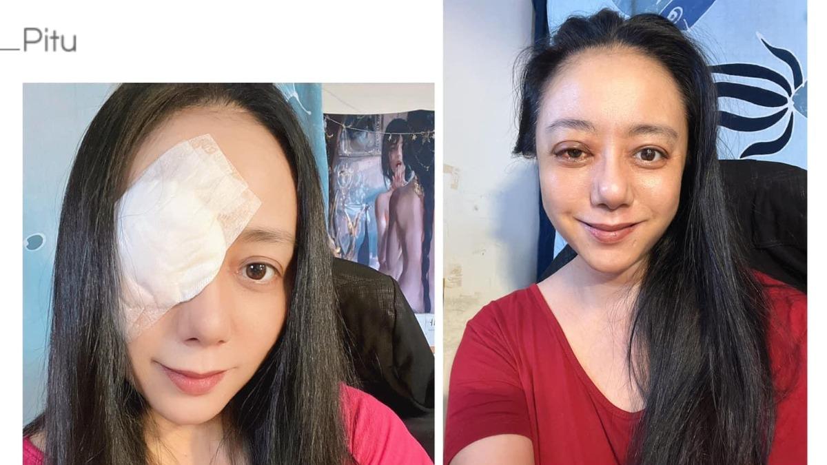 高慧君因甲狀腺機能低下，出現斜視的症狀。（圖／翻攝自高慧君臉書）