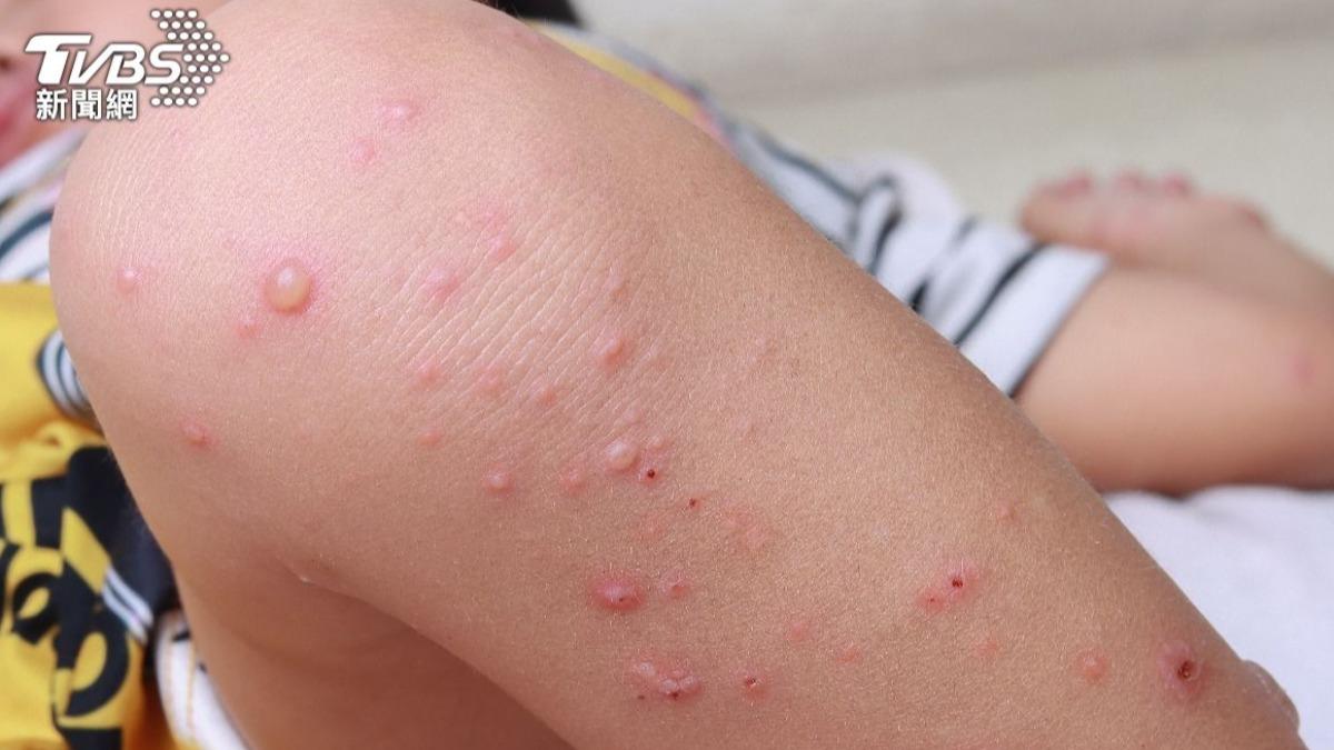 近5年最兇腸病毒!5徵兆快就醫 再拖恐脫水「痛哭無淚」