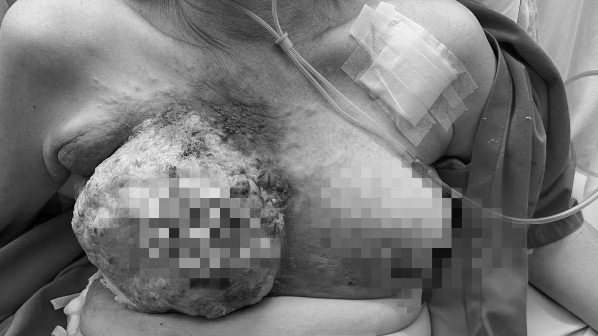 胸有傷口塗偏方!台中女「栗子腫成釋迦大」 拖到變不可逆癌末