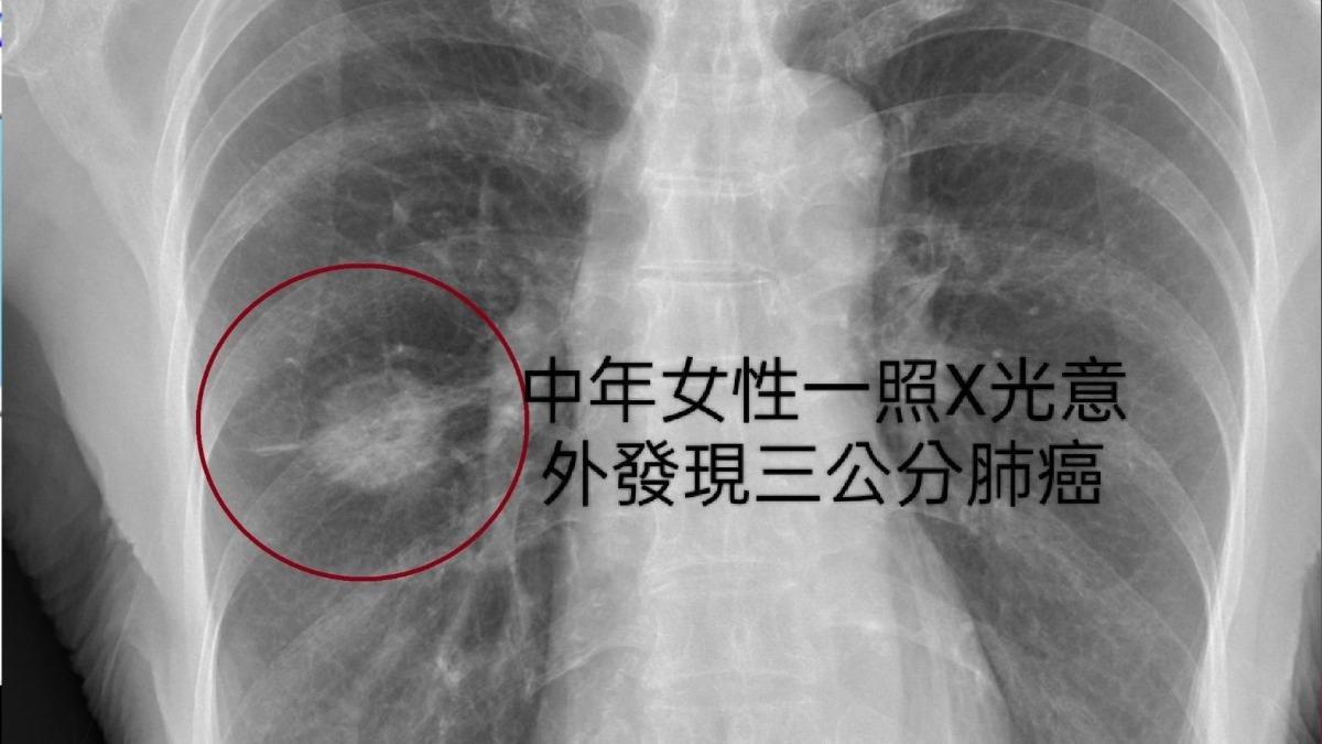夫妻都得肺癌!「1元凶」曝光 醫:這家庭是發生什麼事