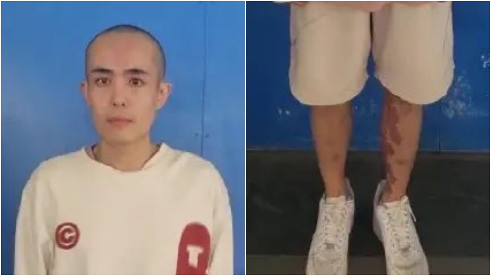 中國男演員星星已變大光頭,腿部疑有傷勢。(翻攝X)
