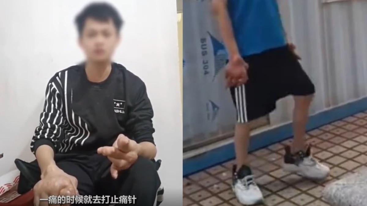 從小愛喝飲料「雙手慘變生薑」 陸男崩潰喊:不敢出門
