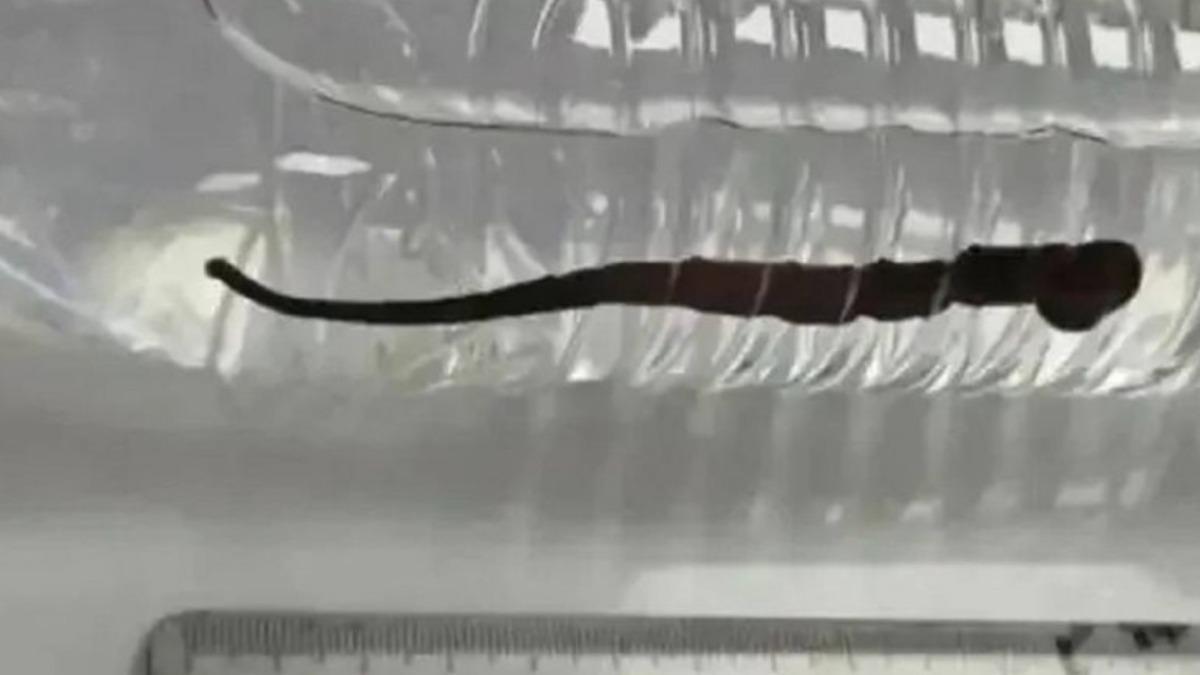 7歲童呼吸不順!下秒「咳出活水蛭」 陸醫嚇傻:12公分寄生氣管