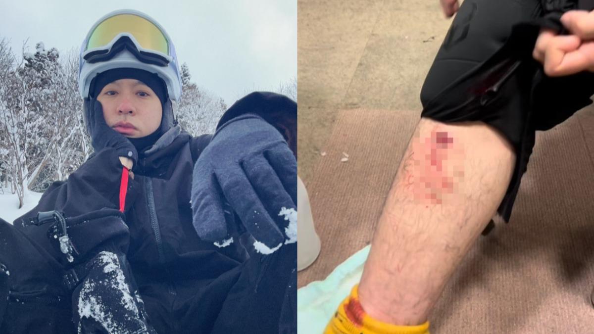 周湯豪日本滑雪出事了！遭撞緊急縫合傷勢曝　本尊發聲揭現況