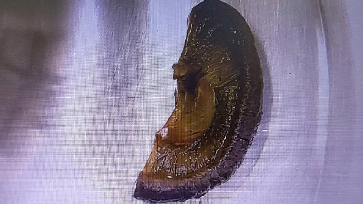 40歲男腹脹狂吐4天 開刀驚見「5公分香菇」卡小腸阻塞