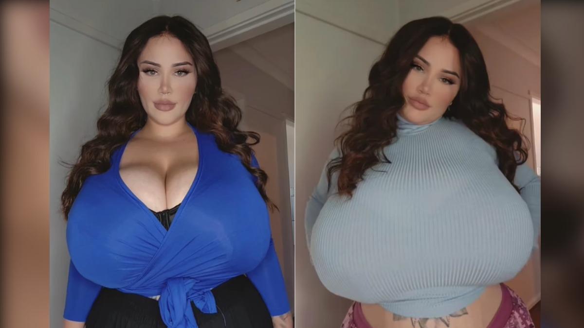 罕見疾病「巨乳症」澳女雙胸飆至P罩杯　曝日收40約會邀請