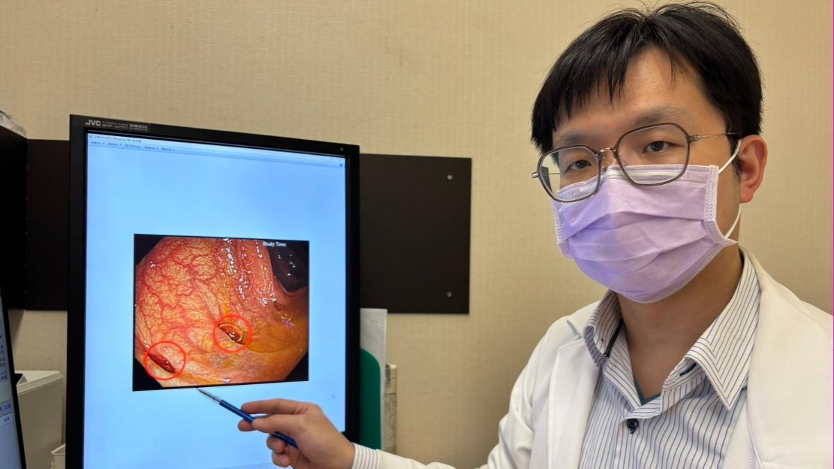 尾牙聚餐太多　男腹痛患大腸憩室炎「拖延恐釀腹膜炎」