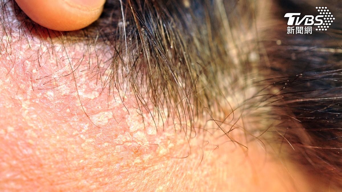 又癢又起屑？恐是「脂漏性皮膚炎」　醫示警：6類食物加劇風險