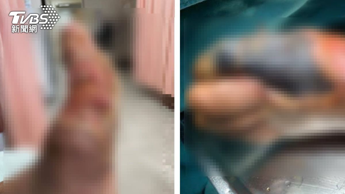 七旬翁剪指甲受傷！一個月潰爛險截肢　醫這招守住42萬手術費