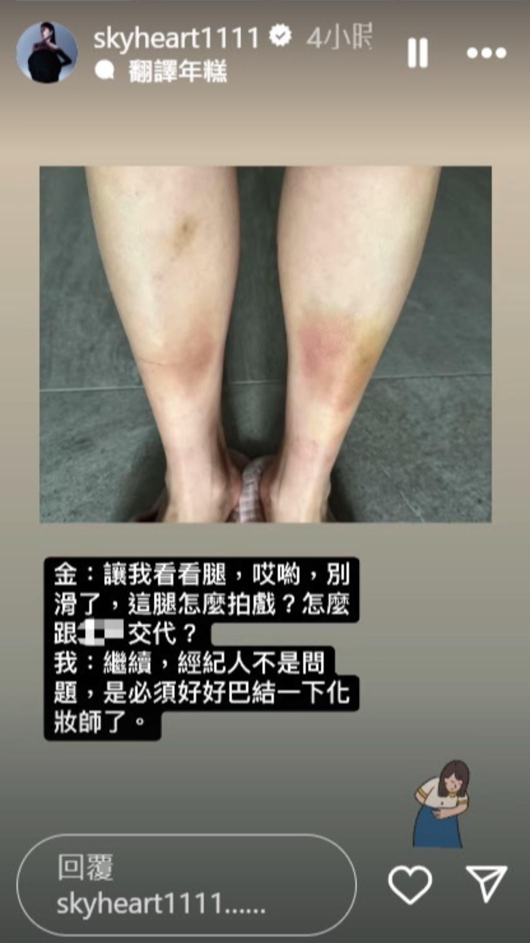 天心雙腿傷勢嚇到老公。(圖/翻攝自IG)