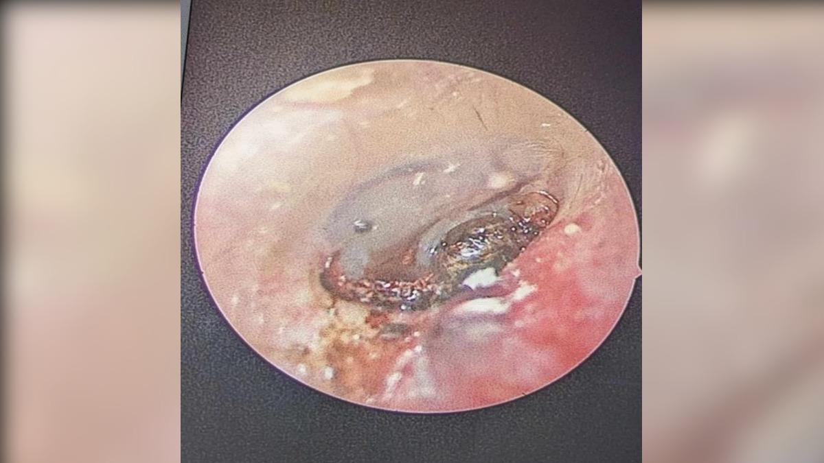 蜱蟲屍體的存在導致「嚴重的神經性聽力損失」。（圖／翻攝自Journal of Medical Case Reports）