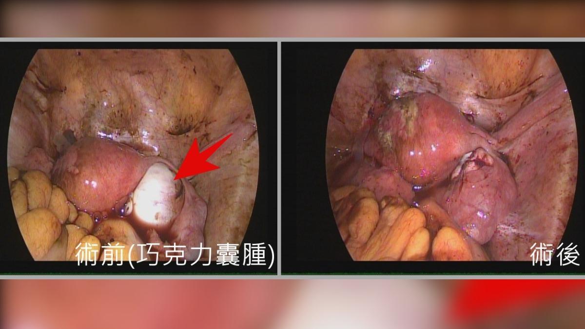 不孕又腹痛!女巧克力囊腫破裂引急性腹膜炎 動刀後3個月懷子