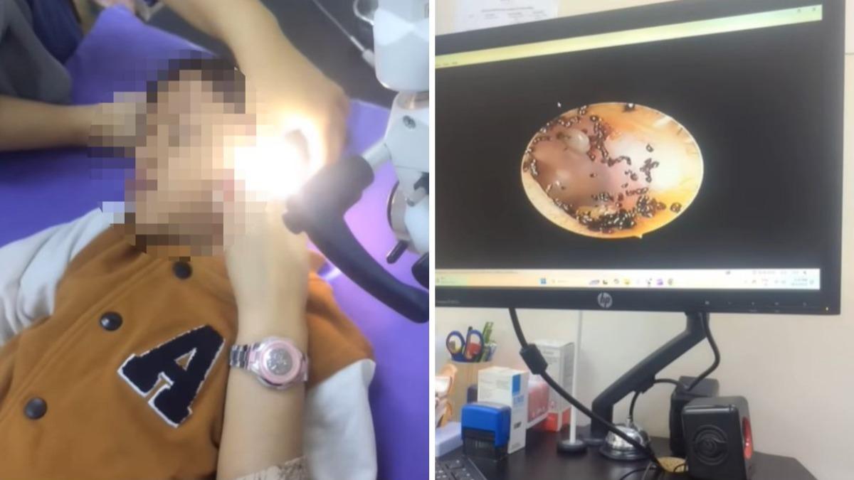 有片/大馬女童喊耳朵痛!醫一照耳道滿是黑點 大量跳蚤炸出