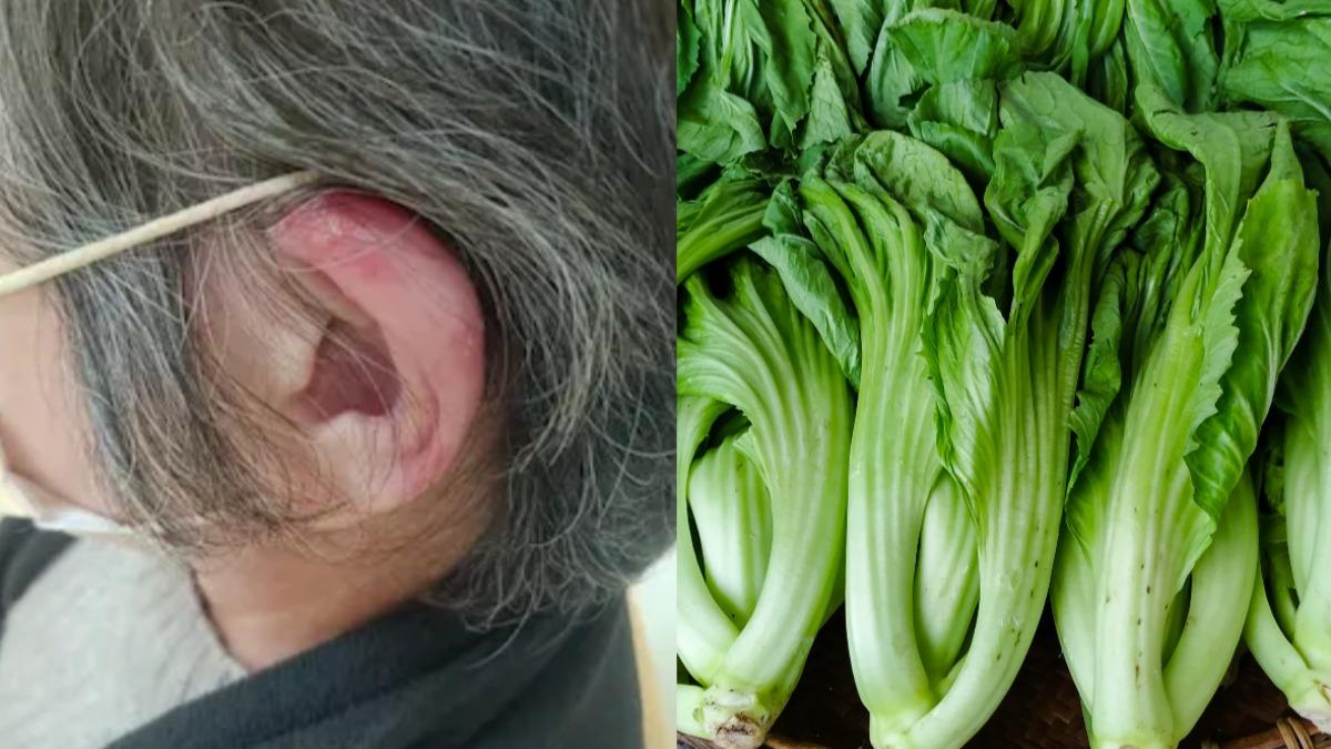 薑母鴨、羊肉爐連補3日 婦人牙齦左耳變超腫!醫:靠1年菜滅火