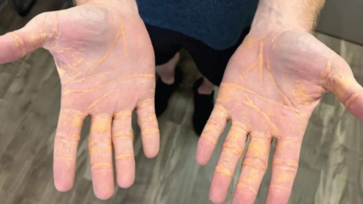 連續8個月只吃肉!40多歲男「四肢滲黃汁」 醫一看當場傻眼