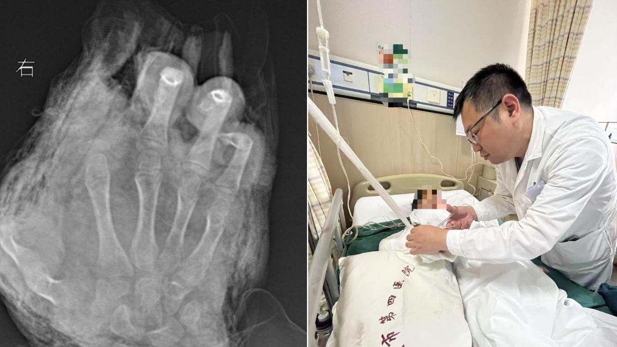 偷拿火藥粉自製鞭炮釀禍 陸12歲屁孩「3根手指全炸斷」