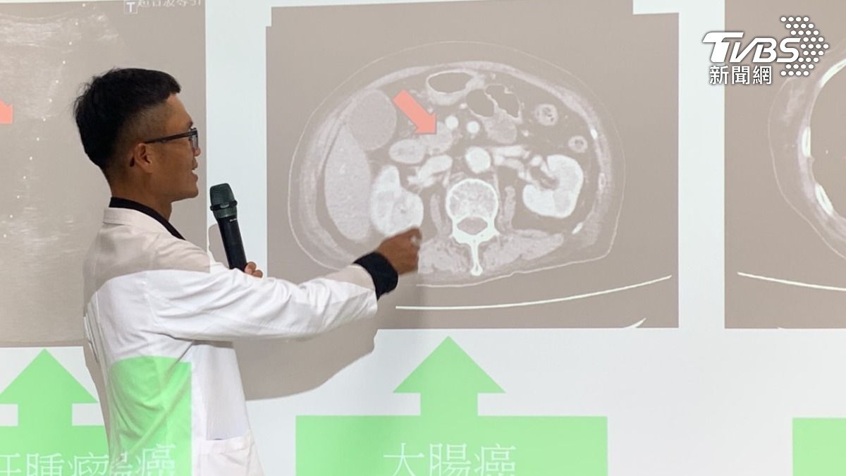 台中婦過年吃壞肚子狂拉 醫一查竟罹2癌「轉移到肝臟」