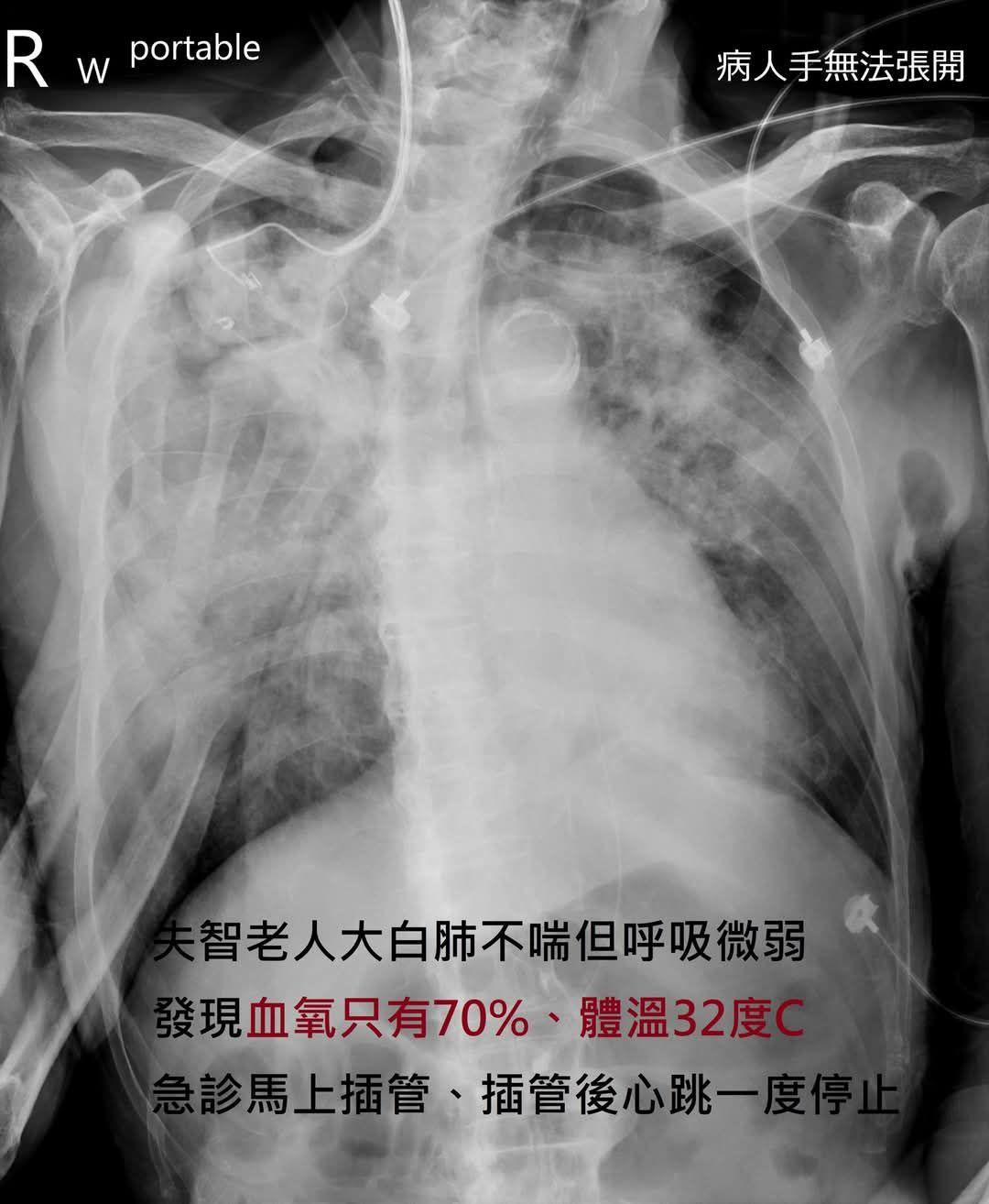 這名失智老人都已大白肺卻不喘。(圖/翻攝自蘇一峰臉書)