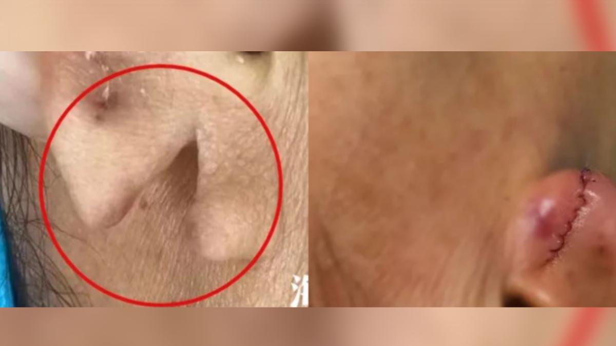 40歲陸女戴重耳環!耳垂突啪一聲「裂成兩半」醫急縫回去