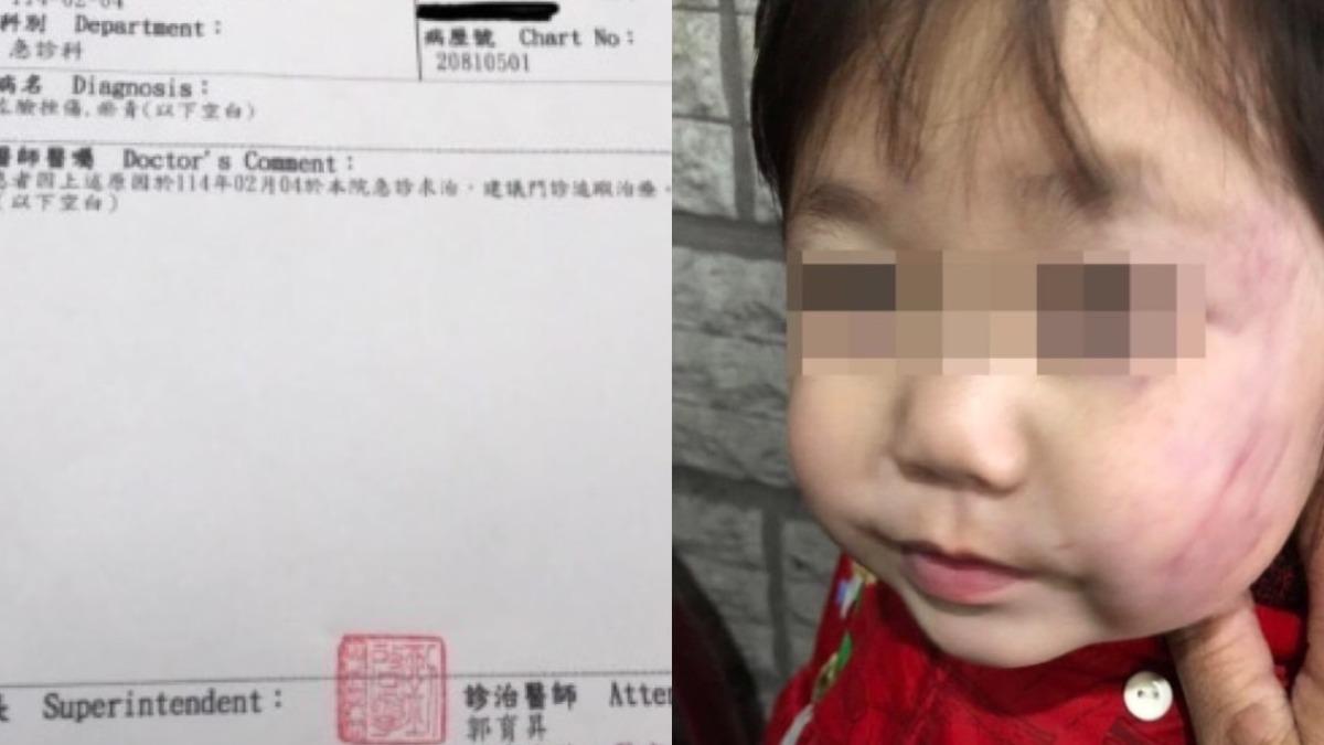 台南補習班疑虐童!女童臉一片瘀青 保母辯「口水巾壓到」:別驗傷