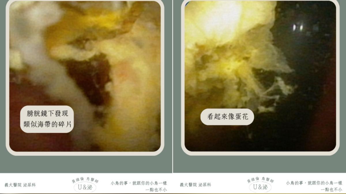 醫師曝光膀胱鏡下畫面。(圖/翻攝自U and泌的鳥醫師.黃維倫臉書)