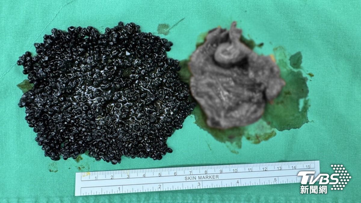 吃火鍋腹痛恐是腹膜炎?民眾開刀取出魚子醬狀膽結石