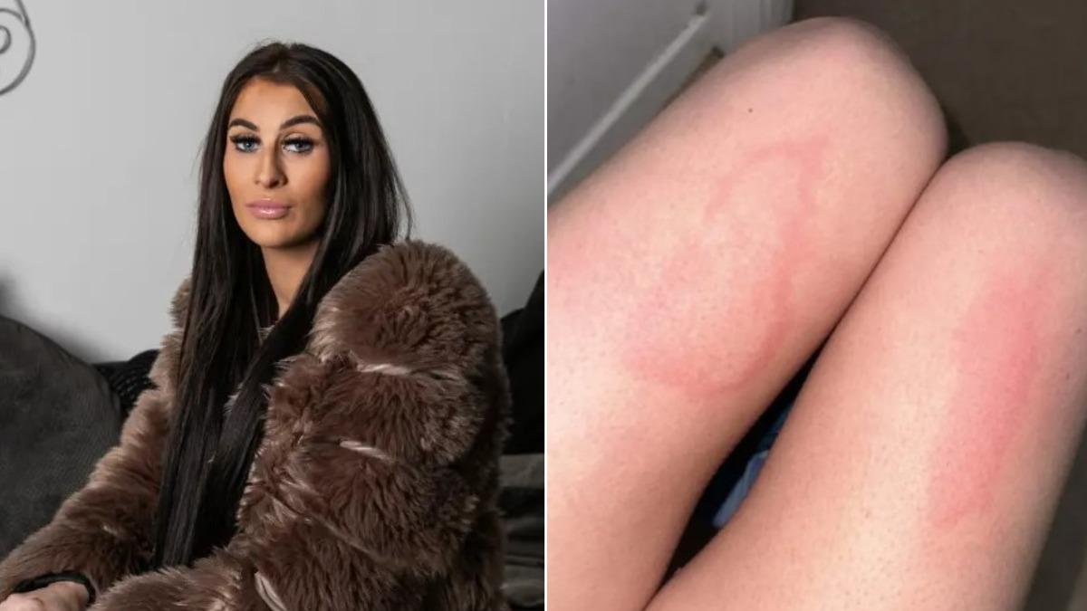 英辣媽罹罕病「對水過敏」 每周只洗2次澡、皮膚碰水秒紅腫