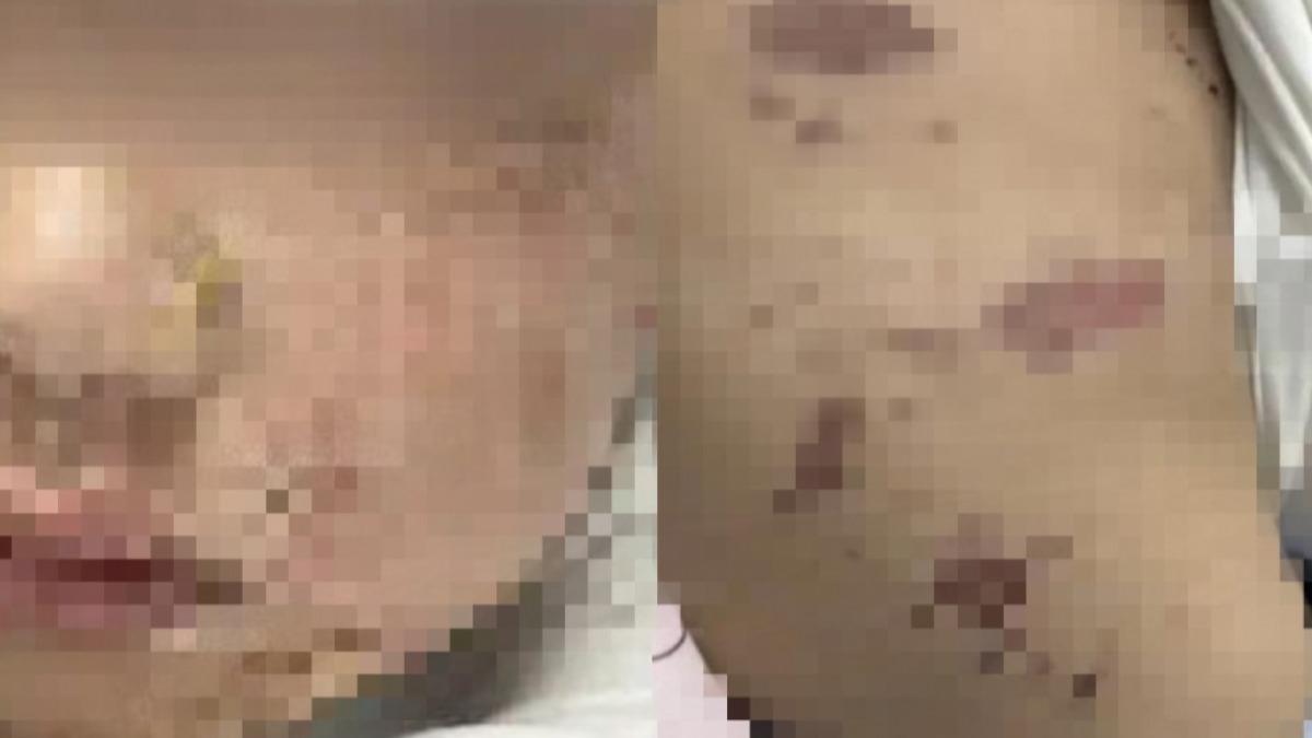 吃火鍋燙傷「3天後全身潰爛」!陸童長滿水泡 醫曝恐怖原因