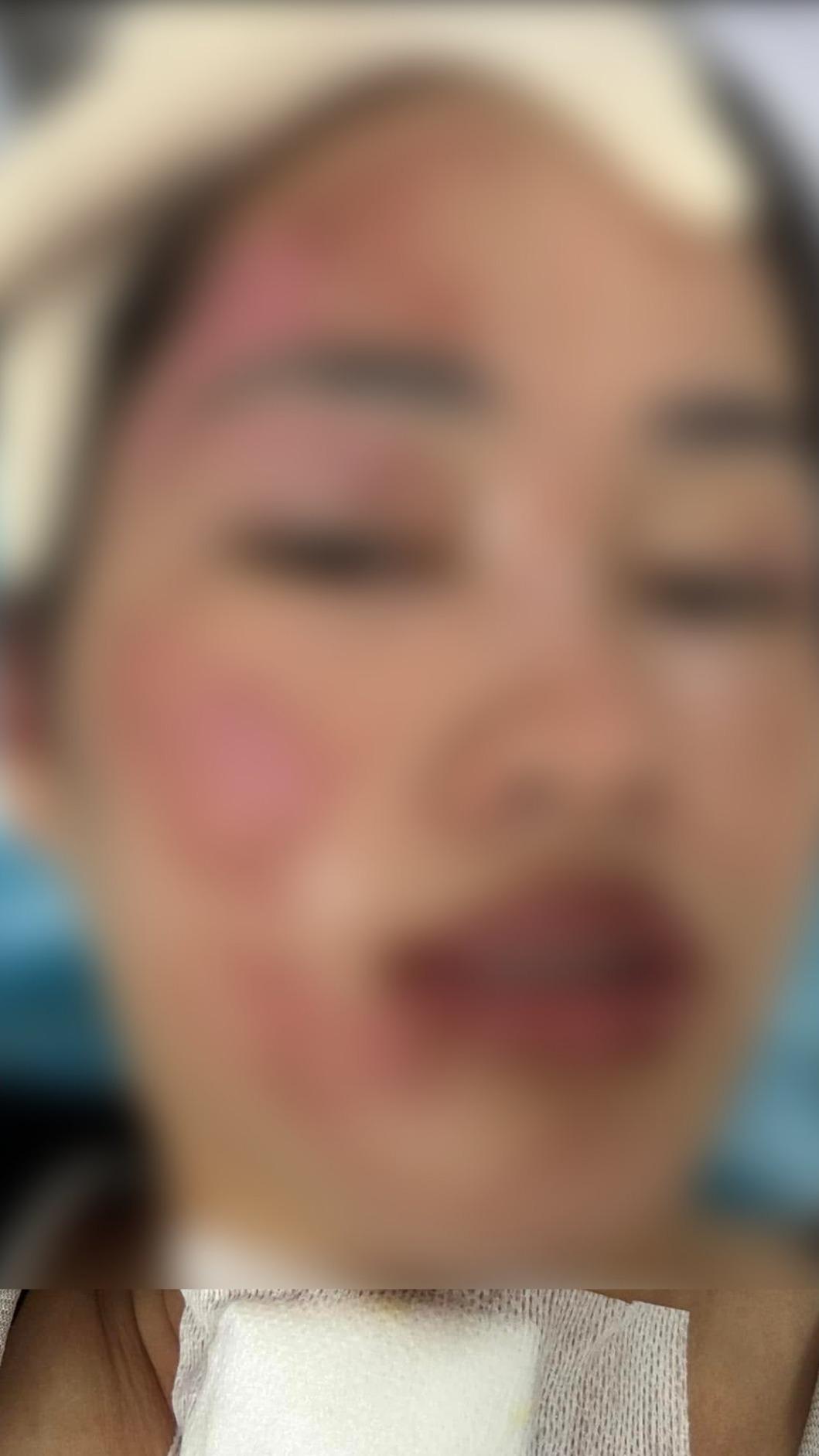 女子半邊臉燒傷。(圖/取自臉書)
