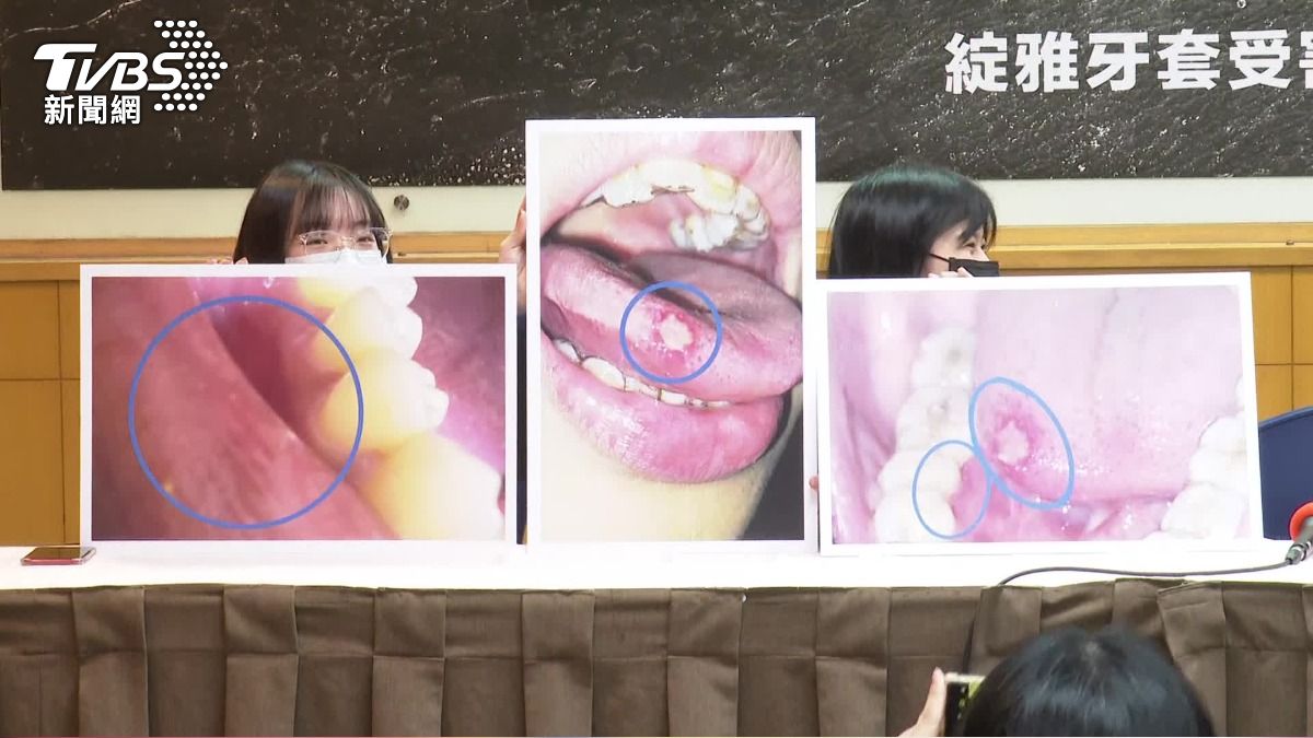 隱形牙套戴出問題！患者控牙齦萎縮、潰爛　組自救會求償千萬