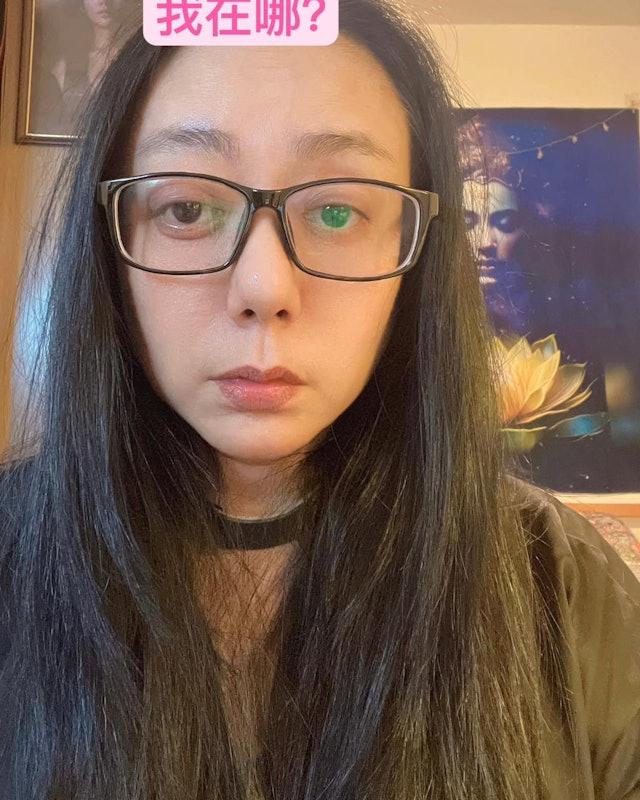 高慧君患病後左右眼嚴重斜視。(圖/翻攝自IG@huichun.kao)