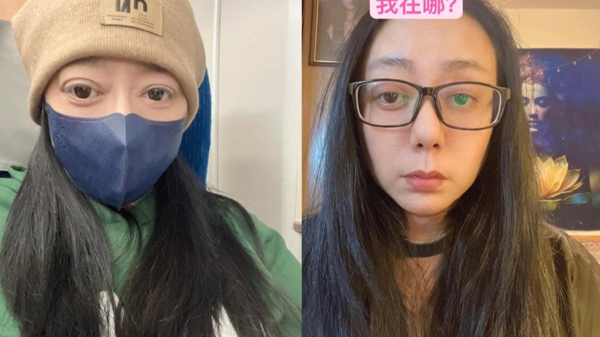 金鐘視后染怪病！整臉「幾近毀容」崩潰：要怎麼活下去