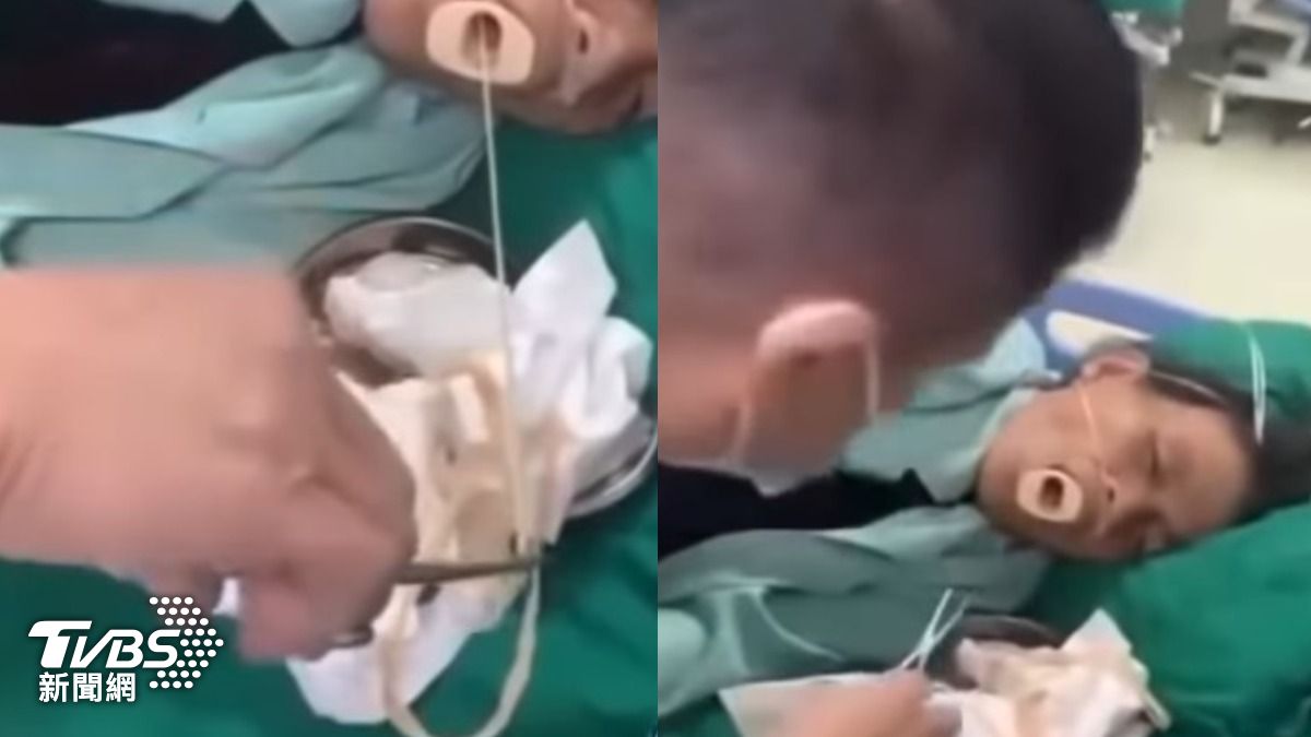 美女病患「口中扯出寄生蟲」!恐長達90m 醫示警1飲食地雷