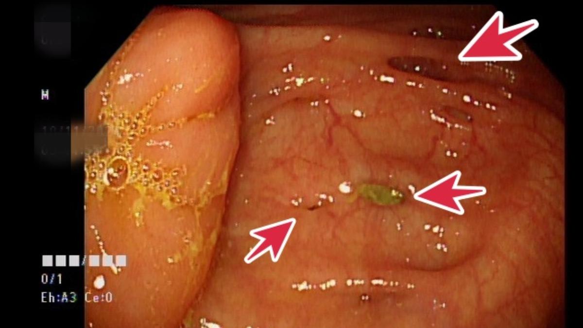 以為腸胃炎!男摸一下肚皮痛4天 醫示警:大腸破糞便外漏更致命