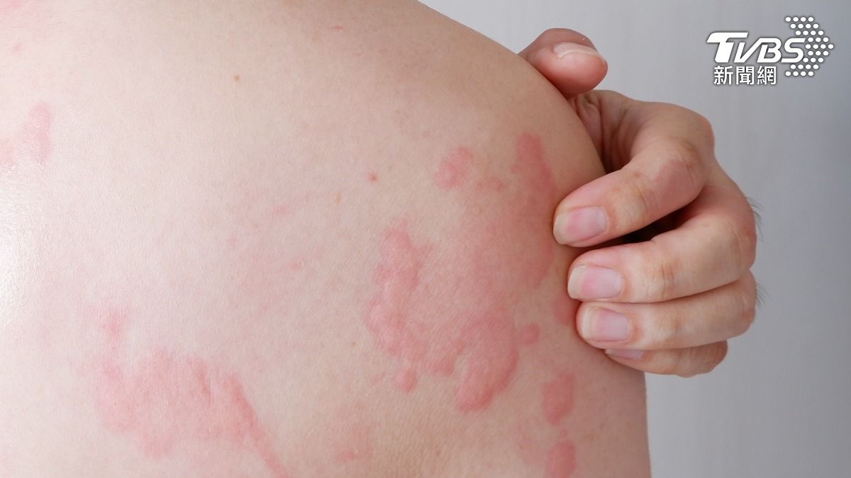 換季皮膚好癢!中醫保養、7種「抗敏食物」5穴道緩解曝光