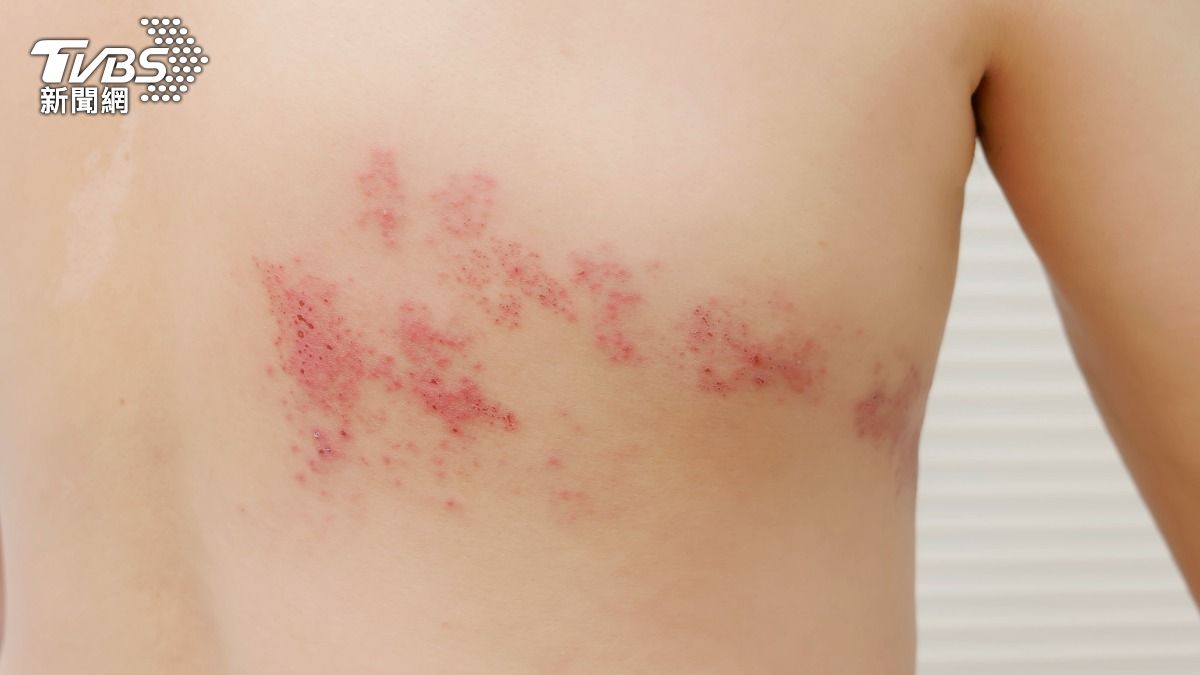 「皮蛇」痛起來像火燒!1族群要當心 醫籲快打帶狀疱疹疫苗